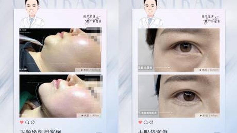 超声炮与射频仪：对抗下垂脸，如何选择更合适的技术？**