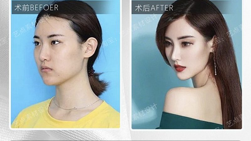 局麻双眼皮手术，揭秘手术步骤与注意事项**