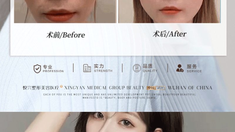 超声炮恢复期抽烟的影响及注意事项