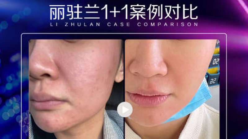 额头皱纹肉毒素注射，费用究竟由何构成？**