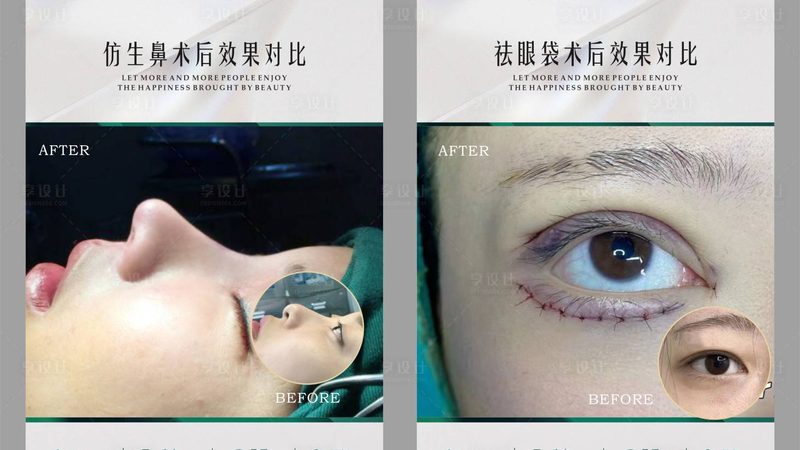 埋线提升，你了解其中的风险吗？**