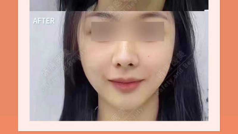 玻尿酸填充：揭秘脸颊塑形的正规医院选择之道**