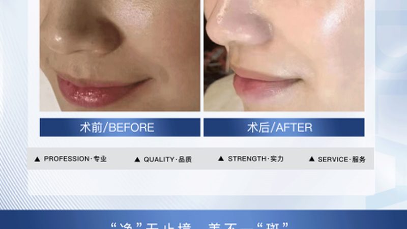 肉毒素除皱，效果维持时间揭秘