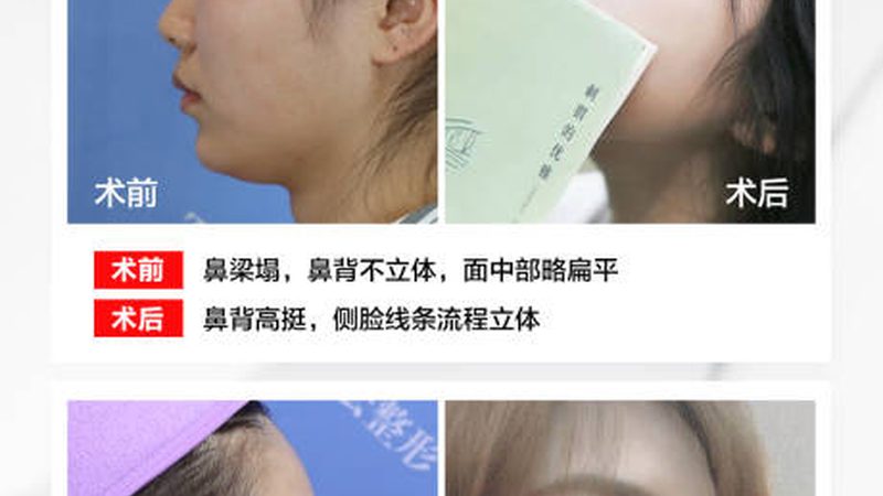 激光祛斑手术：了解副作用，选择专业医院