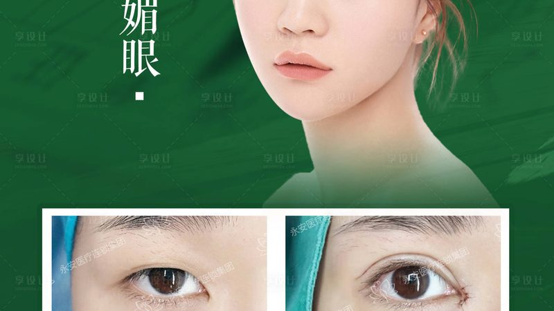 误区一：双眼皮越宽越好