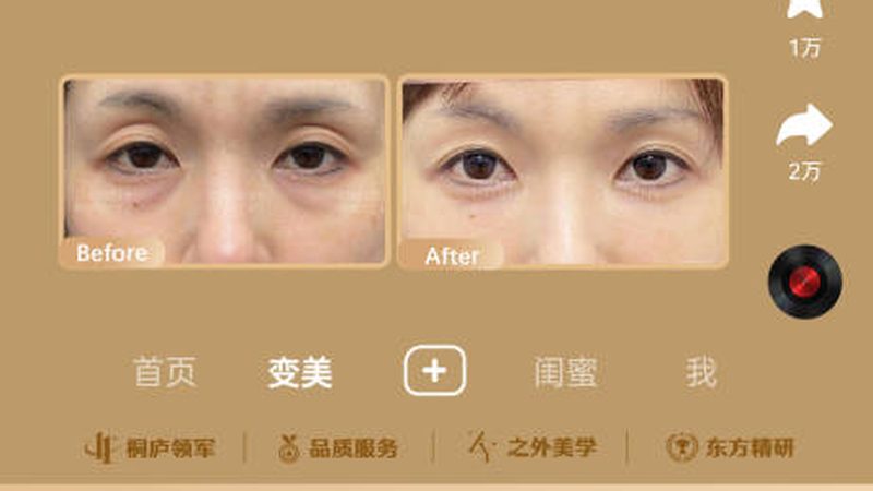 隆鼻假体取出术后，如何科学恢复？**