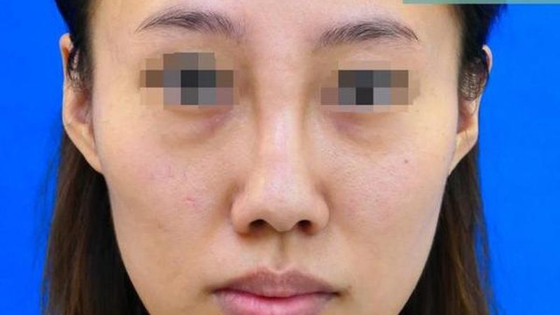 重庆整形医院隆鼻材料安装，揭秘专业步骤与注意事项
